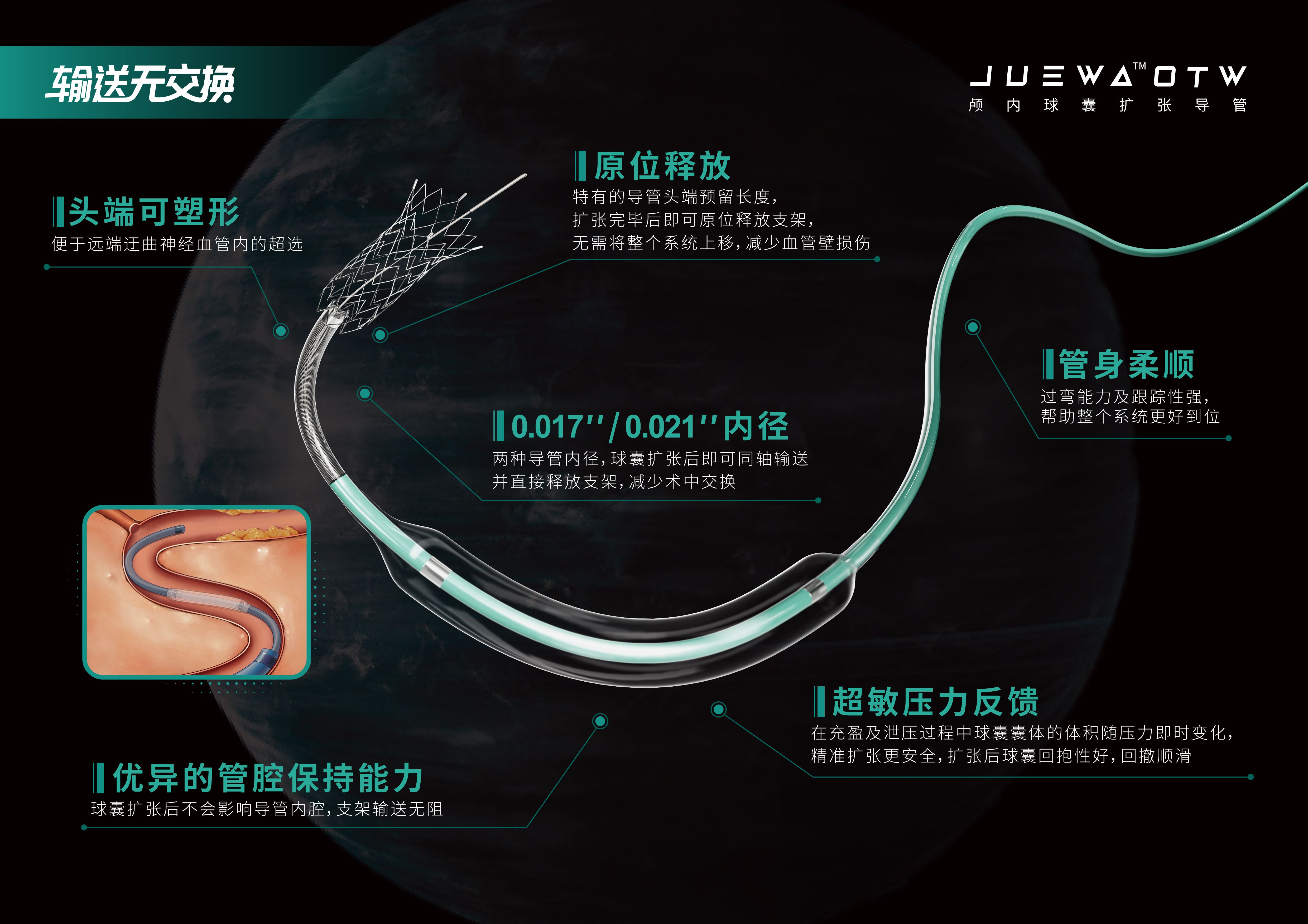 励楷Juewa OTW颅内球囊扩张导管在左侧颈内动脉虹吸段闭塞取栓术中的应用